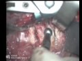 Cervical corpectomy and fusion - Anterior approach