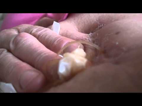 how to treat oozing wounds