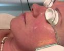 Photorejuvenation Photorejuvenation