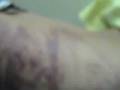 videos de WOMAN HURT IN CAR CRASH -Hematomas y lesiones múltiples en mujer por accidente de tránsito.2 de 3