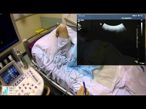 hepatic biopsy - This concept video shows how Google Glass could be used to assist in image guided procedures such as this ultrasound guided liver biopsy. Note how the operat...