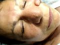 Terry Binns Using Cirepil Blue Wax to Remove Hair on Nose