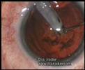 Operacion miopia con lente intraocular