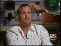 An \"Anchorman\" Hair Transplant--Results