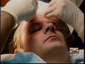 An Anchorman Hair Transplant--Results