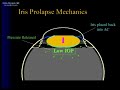 management of iris prolapse during cataract surgery / phaco management of iris prolapse during cataract surgery / phaco