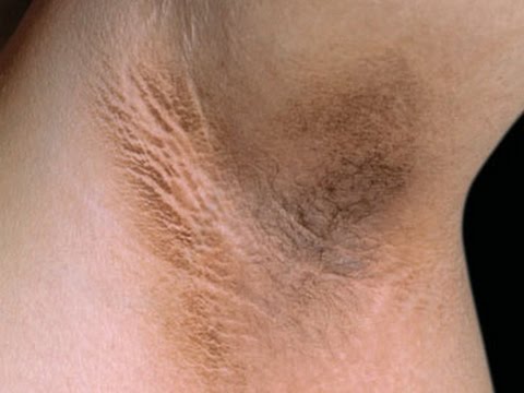 how to whiten black underarms
