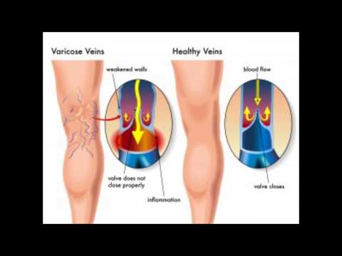 how to treat varicose veins