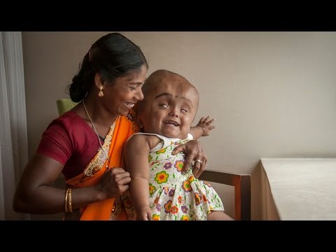 BABY - Swollen Head Baby: Roona Begum's Incredible Journey SUBSCRIBE: http://bit.ly/Oc61Hj A TODDLER whose head swelled to three times its natural size is undergoing a dramatic resurgence. Three-year-o...