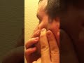 MASSIVE ZIT EXPLOSION