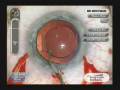 videos de Crystalens HD anterior vault and surgical reposition