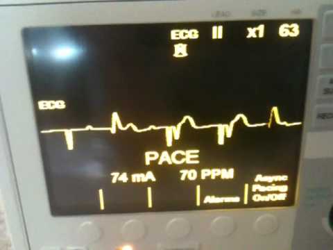 how to treat 3rd degree heart block