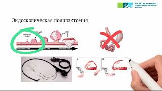 Способы удаления полипов ЖКТ