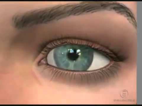 Видео Диабетическая ангиопатия сетчатки и ее лечение