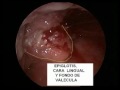 CANCER DE  LARINGE