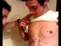 liposucci�n a andres