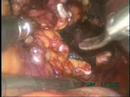 Laparoscopic Adrenalectomy