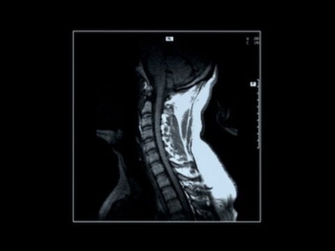 how to remove kyphosis