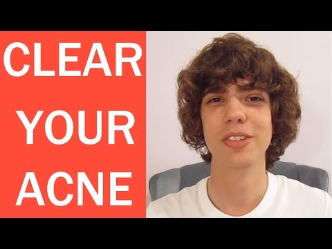 how to get rid of acne so fast