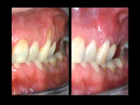 how to treat receding gums