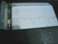 thermowriter ecg with extrasystoles thermowriter ecg with extrasystoles