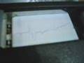 thermowriter ecg with extrasystoles