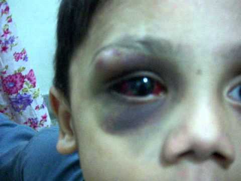 how to cure purpura
