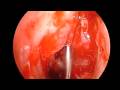 Resection of Haller Cell and Concha Bullosa Resection of Haller Cell and Concha Bullosa