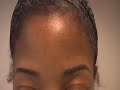 The Acne Practice  (mini bumps 1)