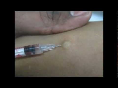 how to administer tb test