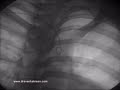 coarctation of aorta collaterals coarctation of aorta collaterals
