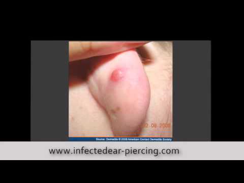 how to cure infected ear piercing