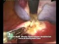 Laparoscopic left adnexectomy on ovarian teratoma
