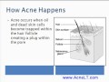 What Causes Acne?