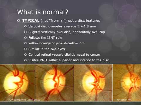 how to assess optic nerve