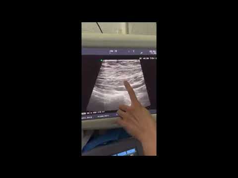 Case 44: Nhóm tổn thương ác tính tuyến vú