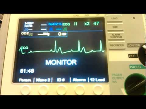 how to treat runs of v tach