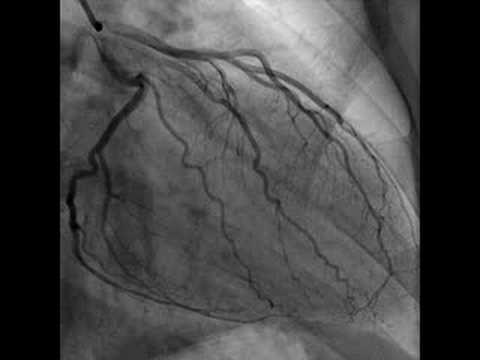 Cardiac Catheterization (Heart video)