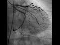 Cardiac Catheterization (Heart video)