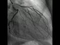 Cardiac Catheterization (Heart video)