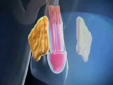 agrandissement penis - Grossir son pénis, obtenir son agrandissement ou l'élargissement pénien: les hommes ont de plus en plus recours à la pénoplastie (appelée aussi phalloplastie...