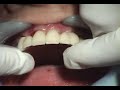 Bionic Teeth