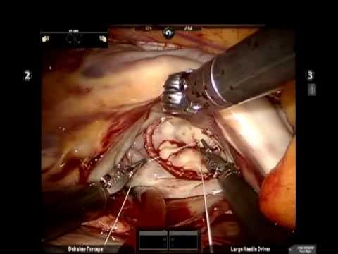 how to repair pfo
