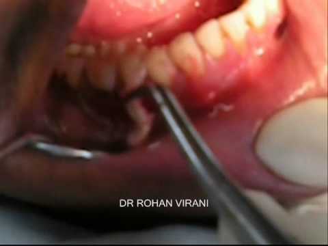 how to treat leukoplakia