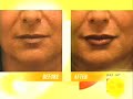 plastic-surgery-lip-enhancement-news-segment-with-dr-lam.html