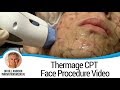 Thermage CPT Face Procedure Video - Dr. Bill Johnson