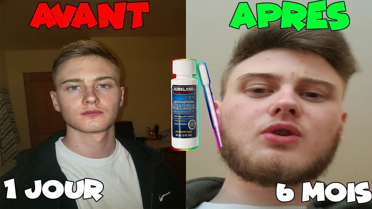 [2022] my minoxidil beard experience before/after!