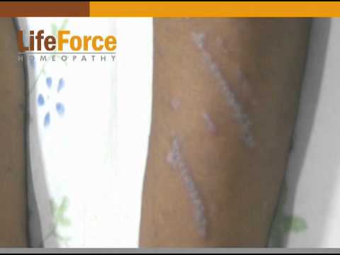 how to treat koebner phenomenon