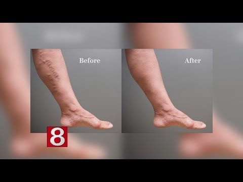 how to relieve vulvar varicose veins