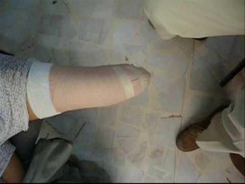 VENDAJE PARA AMPUTACIÓN ABAJO DE RODILLA /PRE PROSTHESIS BANDAGE